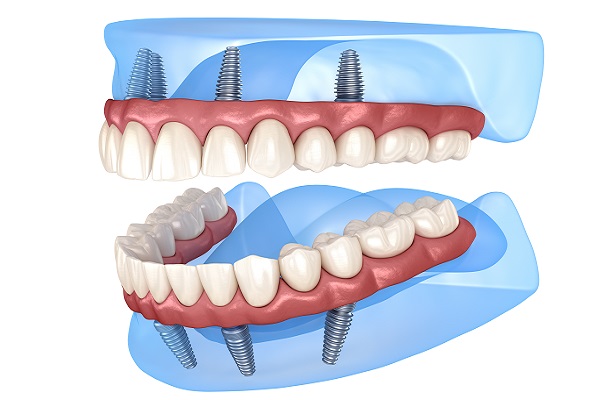 All On  ® Is A Full Arch Dental Restoration