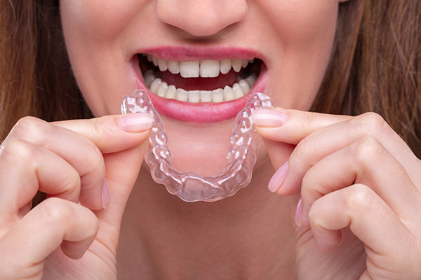 Are Clear Aligners Convenient?