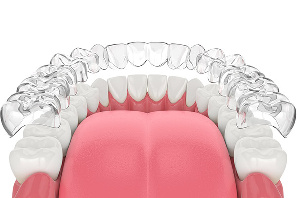 Do You Still Need Dental Care During Clear Aligners Treatment? from SmileWell Family Dentistry in Torrance, CA