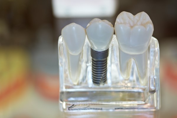 Dental Implants Torrance, CA