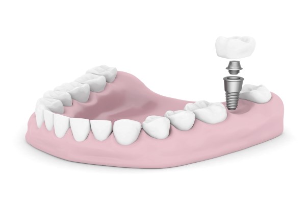 Dental Implants Torrance, CA