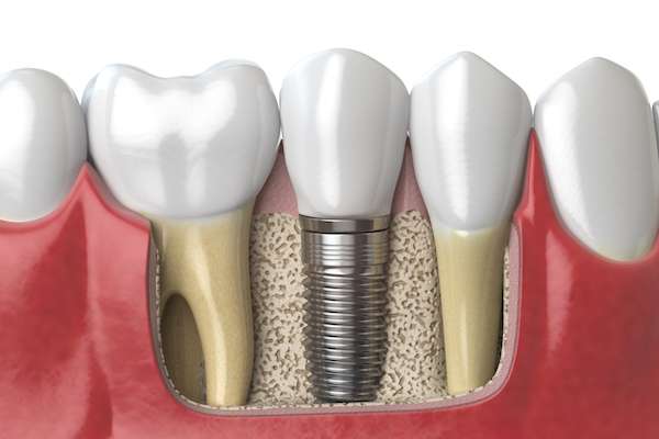 Dental Implants for Replacing Missing Teeth from SmileWell Family Dentistry in Torrance, CA