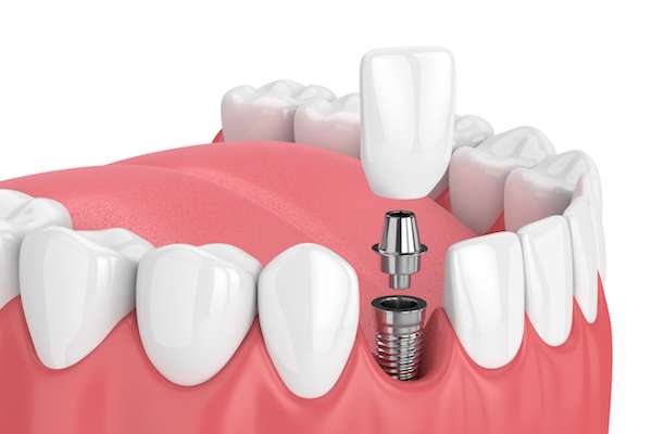 How Painful is Dental Implant Surgery from SmileWell Family Dentistry in Torrance, CA