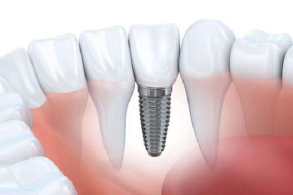 Ask An Implant Periodontist About Implants, Gum Tissue And Jawbone