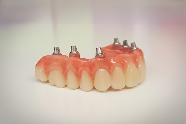 A Guide To The Implant Supported Dentures Procedure