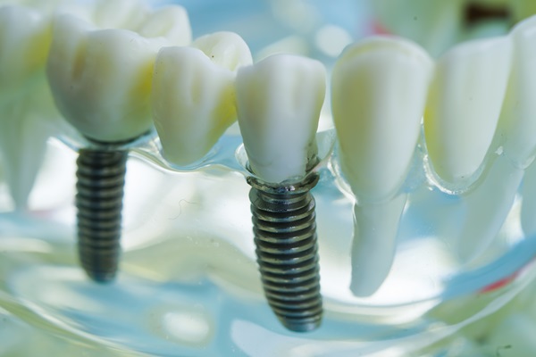 Surgical Implants Are A Long Term Missing Teeth Solution