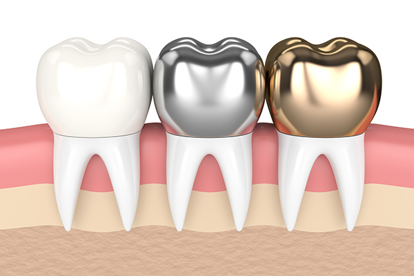 Metal Crowns vs. Porcelain Dental Crowns from SmileWell Family Dentistry in Torrance, CA