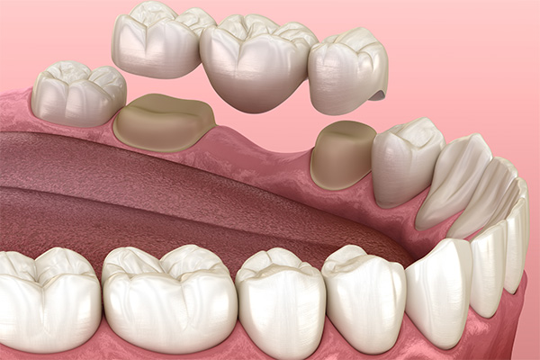 Options for Replacing Missing Teeth: An Overview of Dental Bridges from SmileWell Family Dentistry in Torrance, CA
