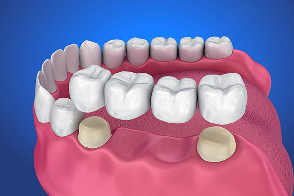 Options For Replacing Missing Teeth: The Benefits Of Dental Implants
