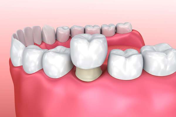 Permanent Dental Crowns vs. Temporary: Is There a Difference from SmileWell Family Dentistry in Torrance, CA