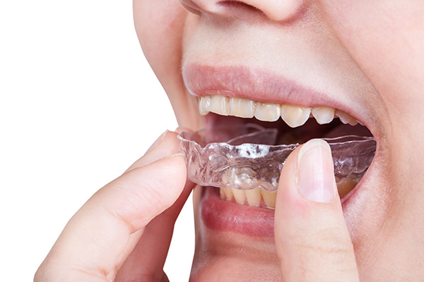 Questions to Ask a Dentist About Clear Aligners from SmileWell Family Dentistry in Torrance, CA