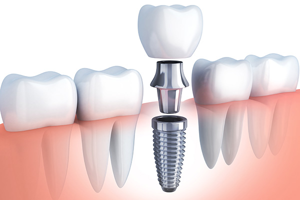 Questions to Ask Your Implant Dentist from SmileWell Family Dentistry in Torrance, CA