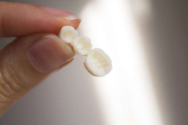Replace Missing Teeth with Dental Bridges from SmileWell Family Dentistry in Torrance, CA