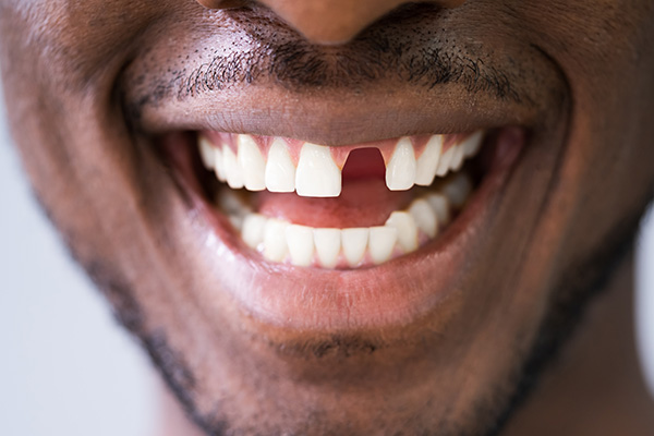 When Should You Seek Options For Replacing Missing Teeth?