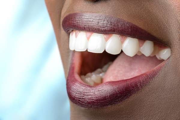 Routine Dental Care: What Are Tooth Colored Fillings from SmileWell Family Dentistry in Torrance, CA